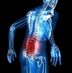 osteochondroză