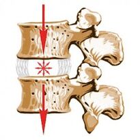 Dispozitivul coloanei vertebrale și cauzele osteochondrozei