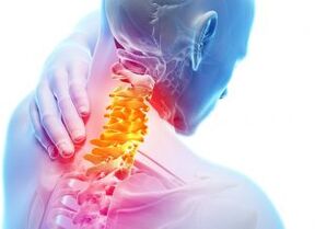 Durere și fulgere în zona cervicală cu osteocondroză de gradul trei