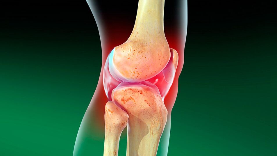 Osteoartrita articulației genunchiului